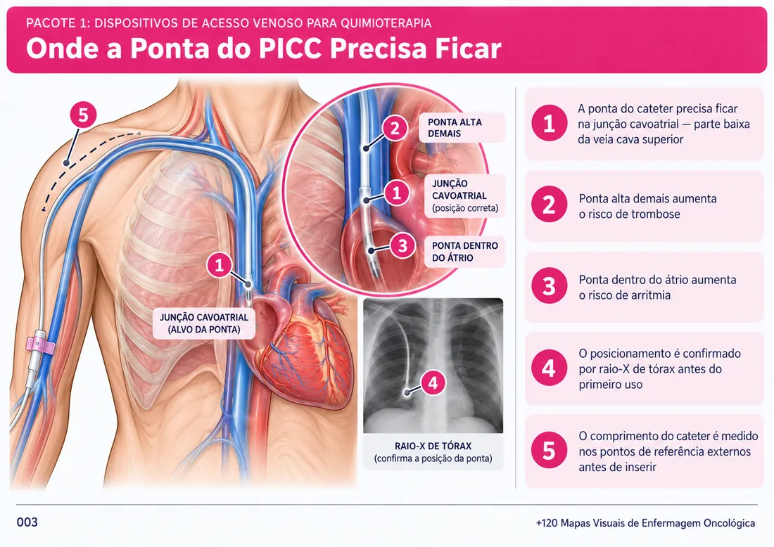 Mapa 003: Onde a Ponta do PICC Precisa Ficar